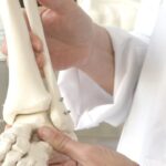 Calzado ideal para recuperación de fractura de peroné