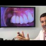 Coronas en implantes dentales ¿Por qué se aflojan?