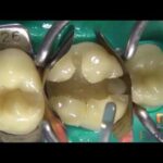 Obturación dental todo lo que necesitas saber