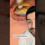 ¿Olvidaste una lentilla en tu ojo? Aprende qué hacer ahora