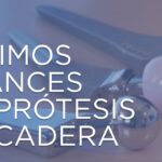 Peso de prótesis de cadera en titanio todo lo que debes saber