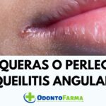 Tratamiento para la boquera en la comisura de los labios